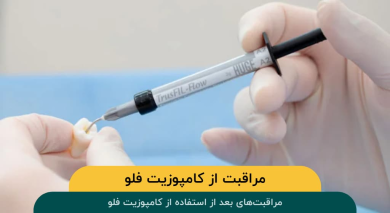مراقبتهای بعد از استفاده از کامپوزیت فلو: راهنمای جامع برای سلامت دندانها